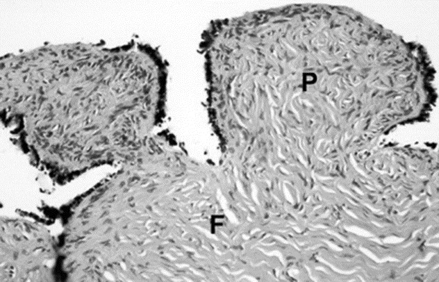 Benign Serous Cystadenofibroma