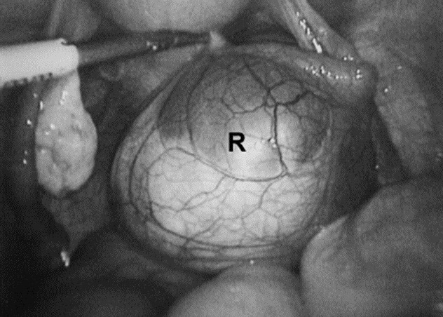 Benign Serous Cystadenofibroma