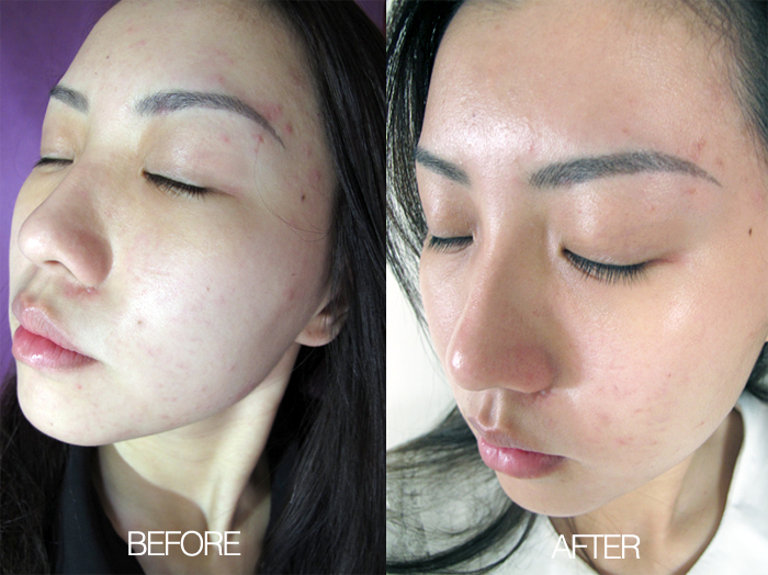 Extraction Facial Before After