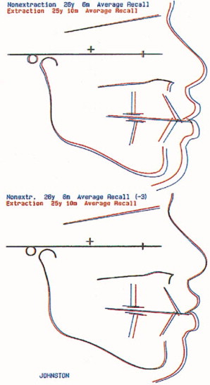 Extraction Facial Chicago