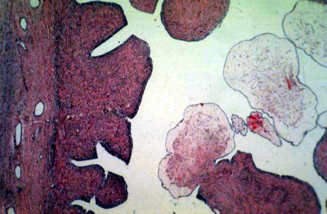 Papillary Serous Cystadenofibroma