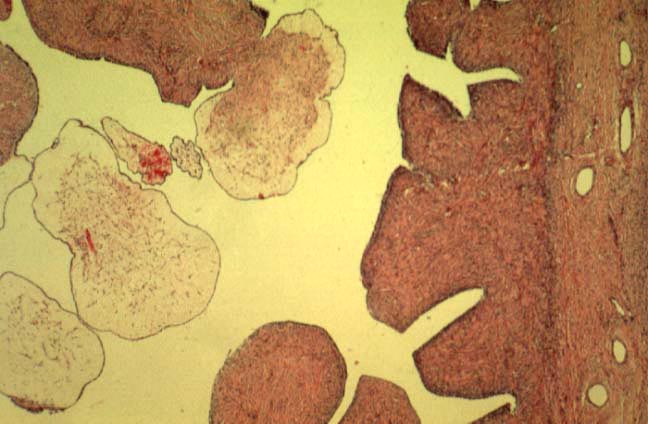 Papillary Serous Cystadenofibroma