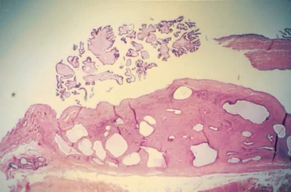 Papillary Serous Cystadenofibroma