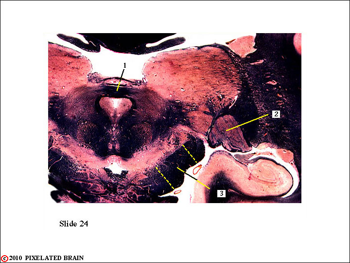 Pupillary Light Reflex Contralateral