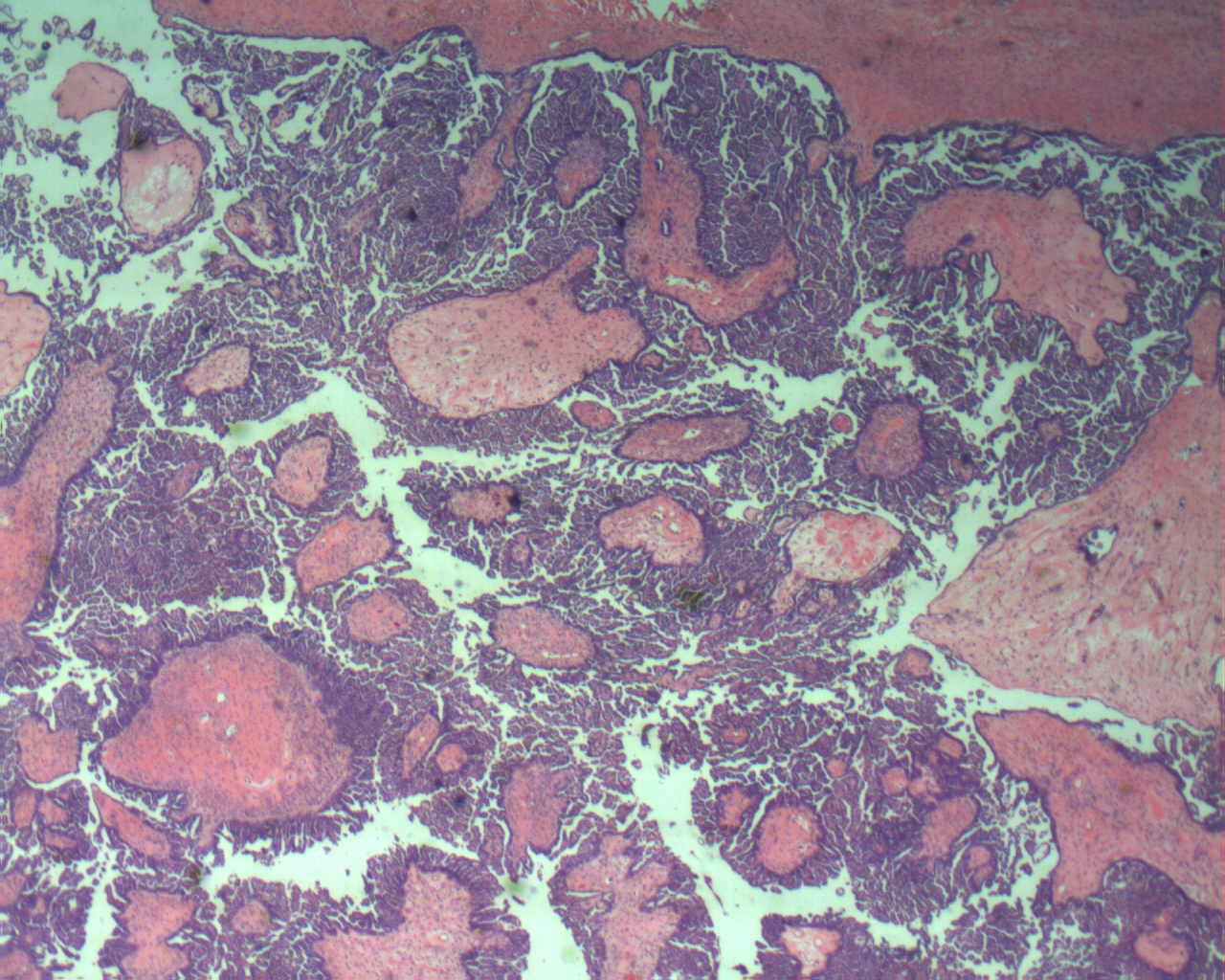 Serous Cystadenofibroma Ovary