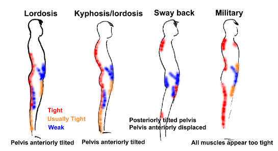 Tilted Pelvis Running