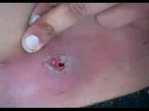 Black Widow Spider Bite Pictures Videos