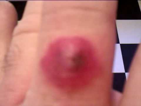 Black Widow Spider Bite Symptoms