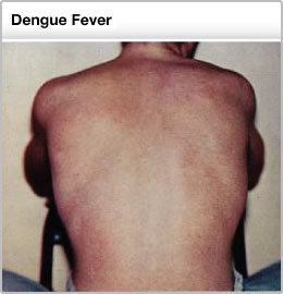 Dengue Rash