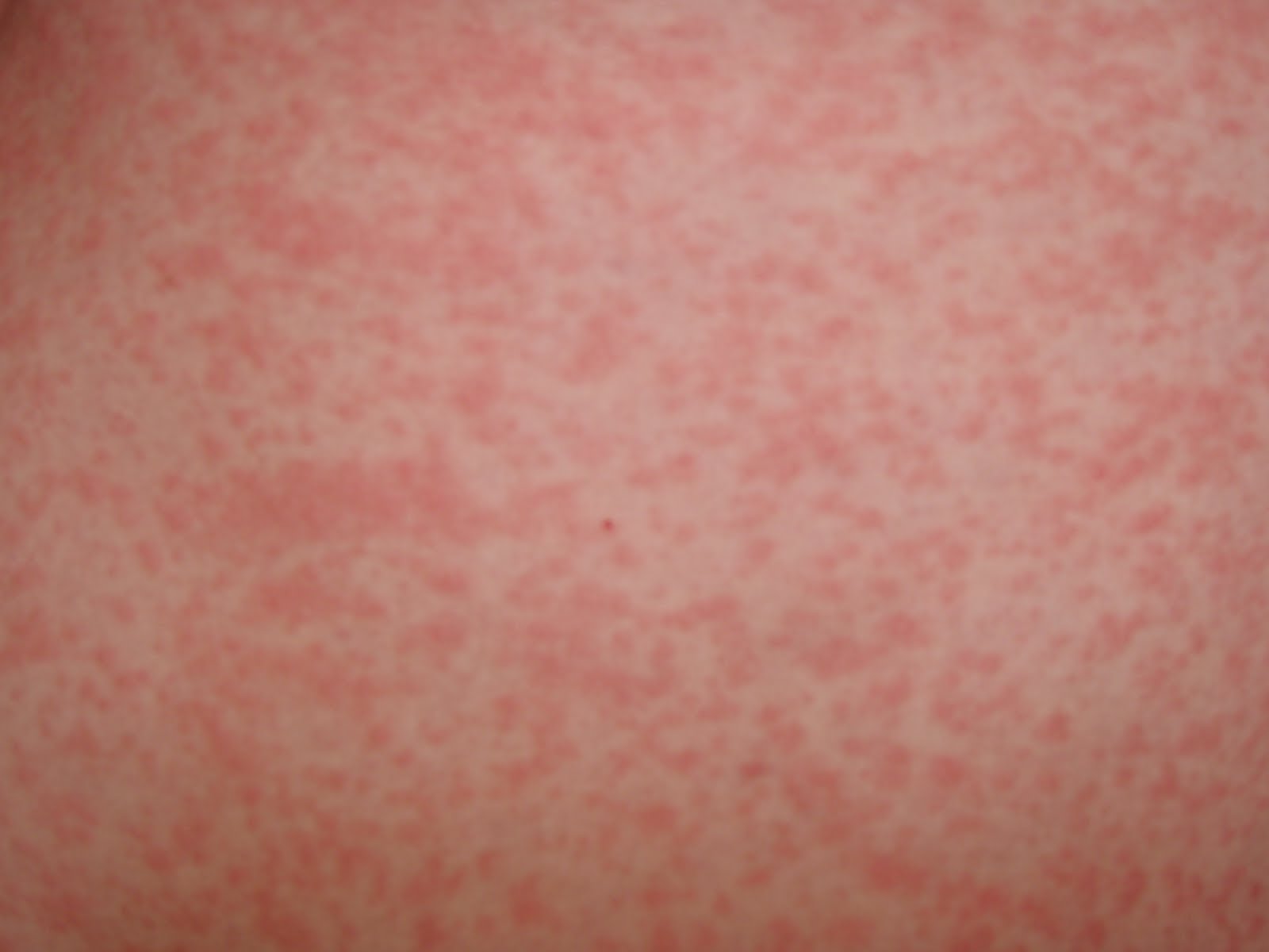 Dengue Rash