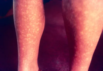 Dengue Rash