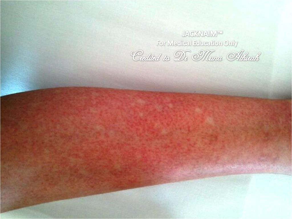 Dengue Rash Pictures