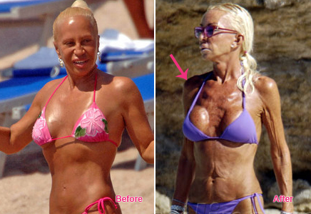 Donatella Versace Before And After Plastic Surgery