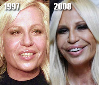 Donatella Versace Before Plastic Surgery 2010