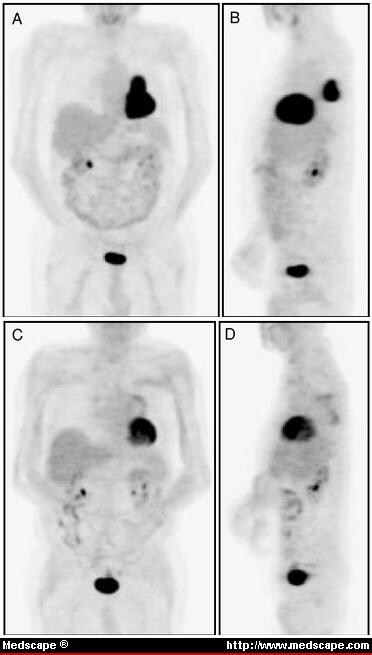 Fdg Pet Scan