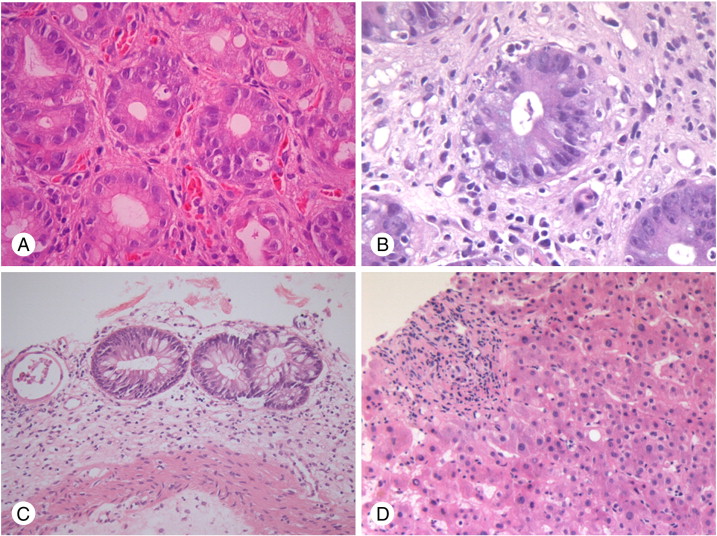 Gvhd Gut Symptoms