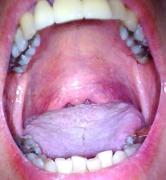 Gvhd Mouth