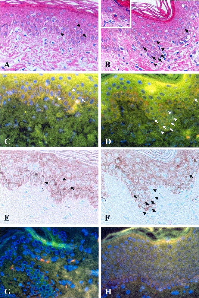 Gvhd Skin Grading