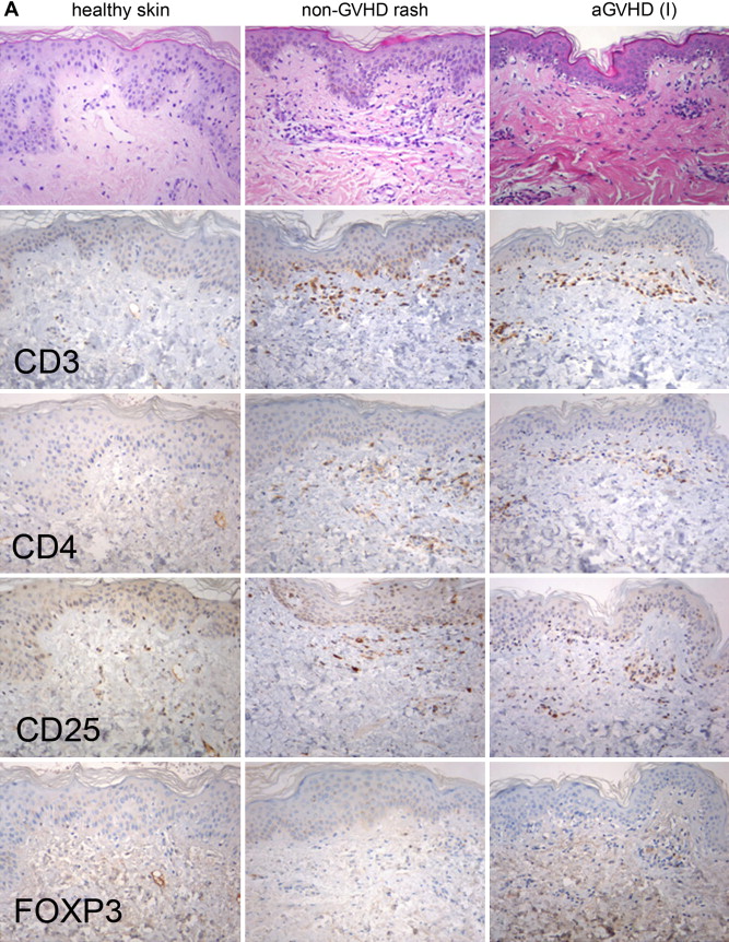 Gvhd Skin Histology