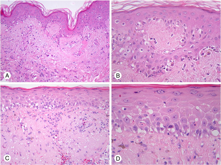 Gvhd Skin Histology