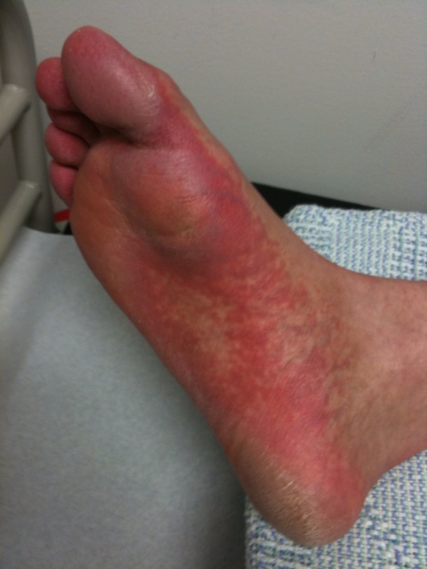 Gvhd Skin Rash