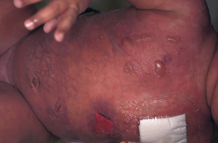 Gvhd Skin Rash Photos