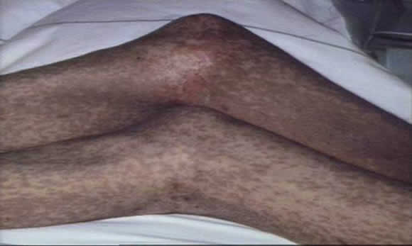 Gvhd Skin Rash Photos