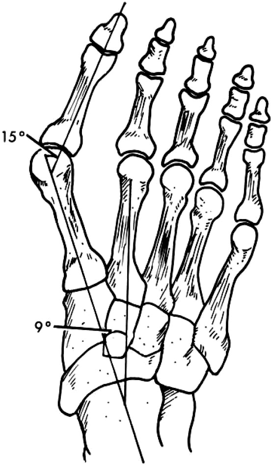 Hallux Valgus Angle