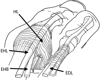 Hallux Valgus Deformity And Prevention