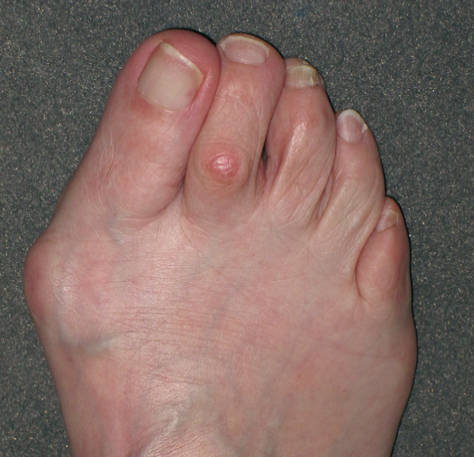 Hallux Valgus Deformity Causes