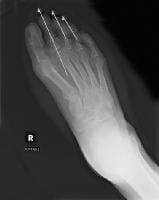 Hallux Valgus Deformity Causes