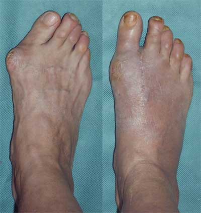 Hallux Valgus Deformity Causes