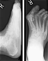 Hallux Valgus Deformity Causes