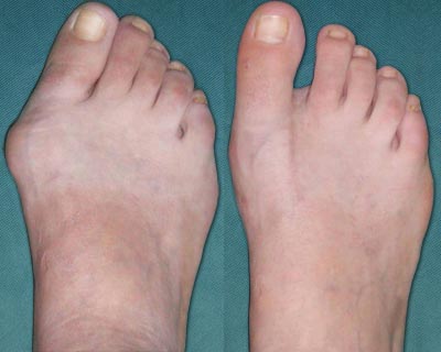 Hallux Valgus Deformity Picture