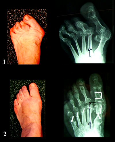 Hallux Valgus Deformity Picture