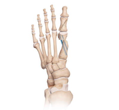 Hallux Valgus Deformity Radiology