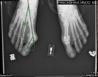 Hallux Valgus Deformity Radiology