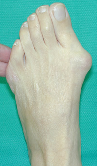 Hallux Valgus Deformity Radiology