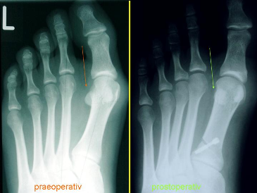 Hallux Valgus Deformity Radiology