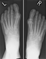 Hallux Valgus Deformity Treatment