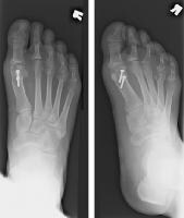 Hallux Valgus Deformity Treatment