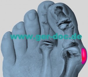 Hallux Valgus Surgery Germany