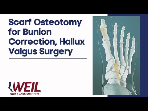 Hallux Valgus Surgery Video