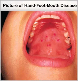 Hfm Disease