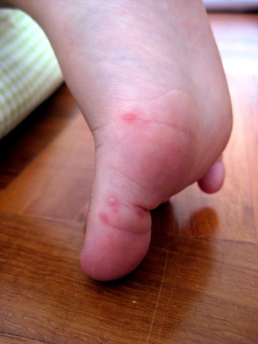 Hfmd Blisters