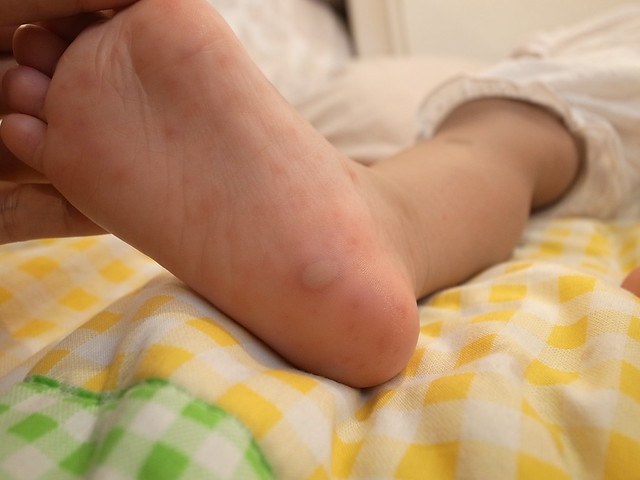 Hfmd Blisters