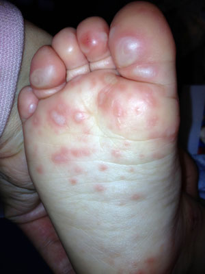 Hfmd Blisters