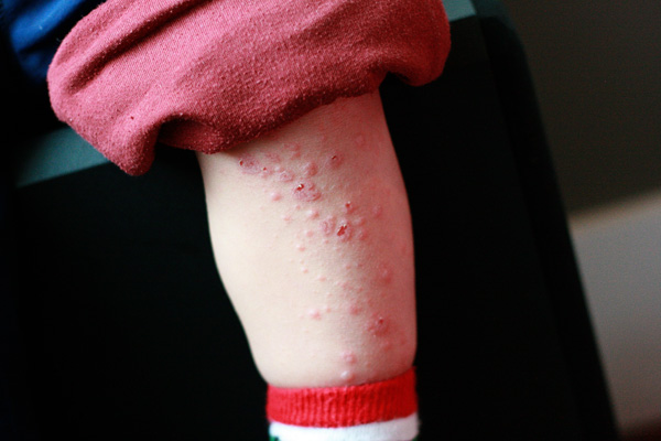 Hfmd Rash