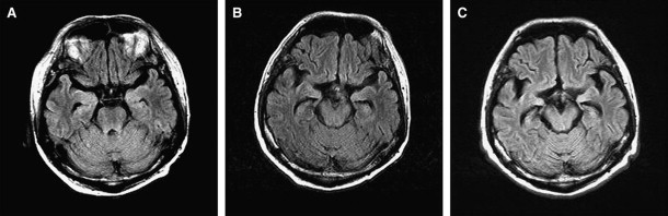 Hhv 6 Encephalitis Mri