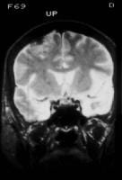 Hhv 6 Encephalitis Mri